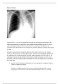 NURS MISC Case Studies - Pneumothorax