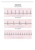 COMPLEX CR NR 341 EKG strips; SINUS RHYTHM Normal Sinus Rhythm Sinus Bradycardia Sinus Tachycardia | Download To Score An A.